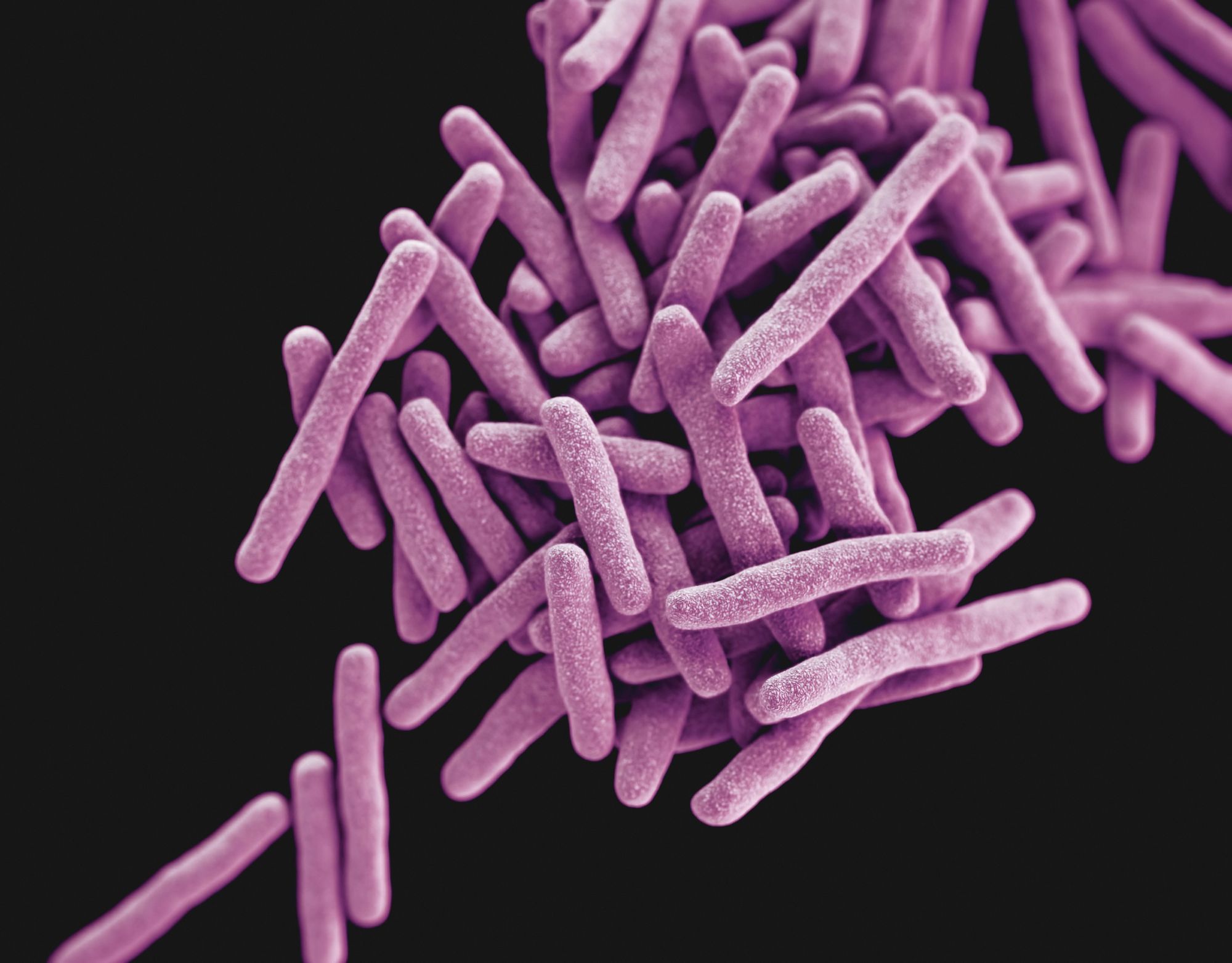 Člověk s tuberkulózou „voní“ jinak – toho využívá průlomový diagnostický nástroj
