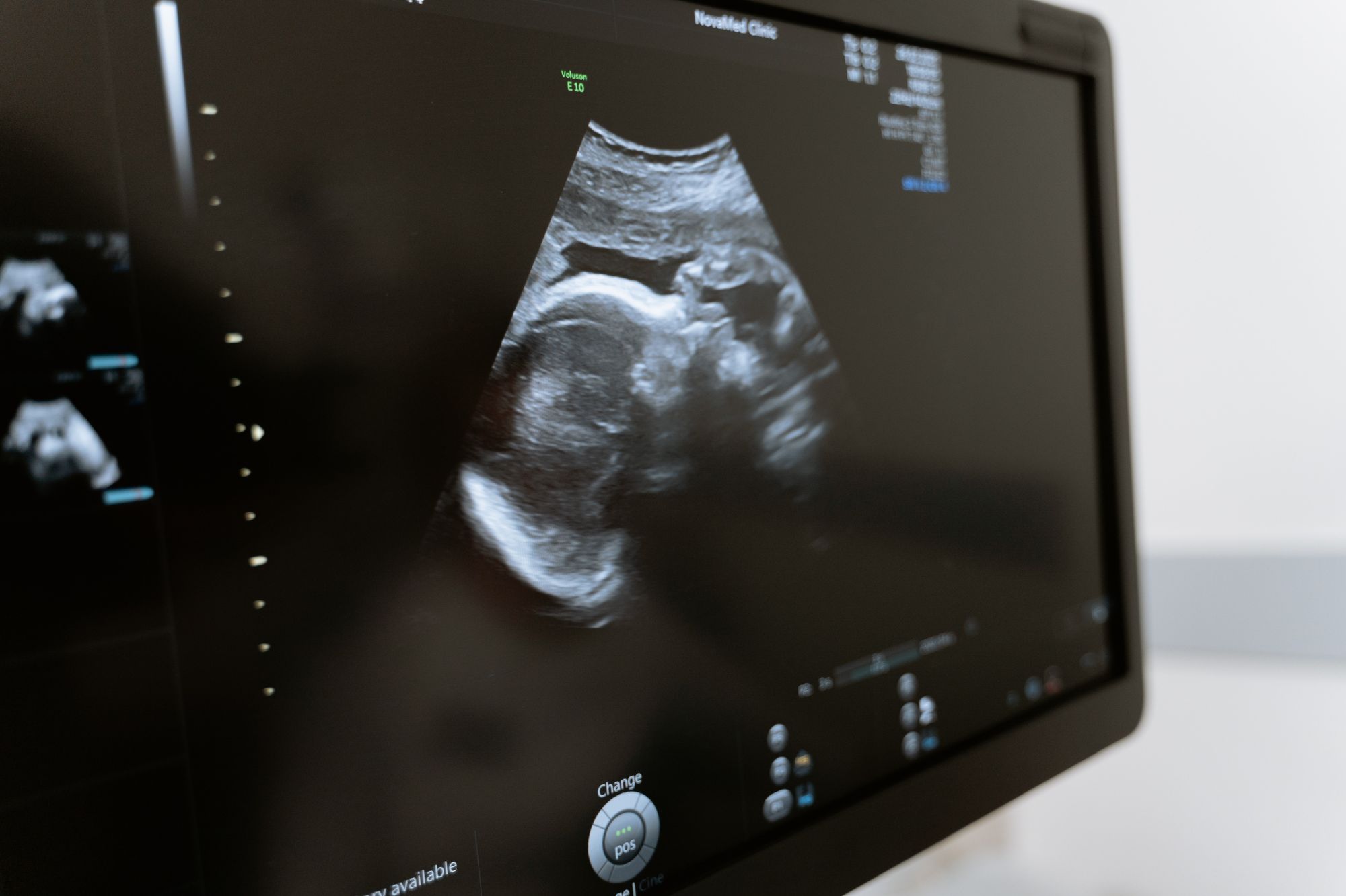 Dočasné potlačení ovulace jako možná zbraň proti genetickým vadám plodu.