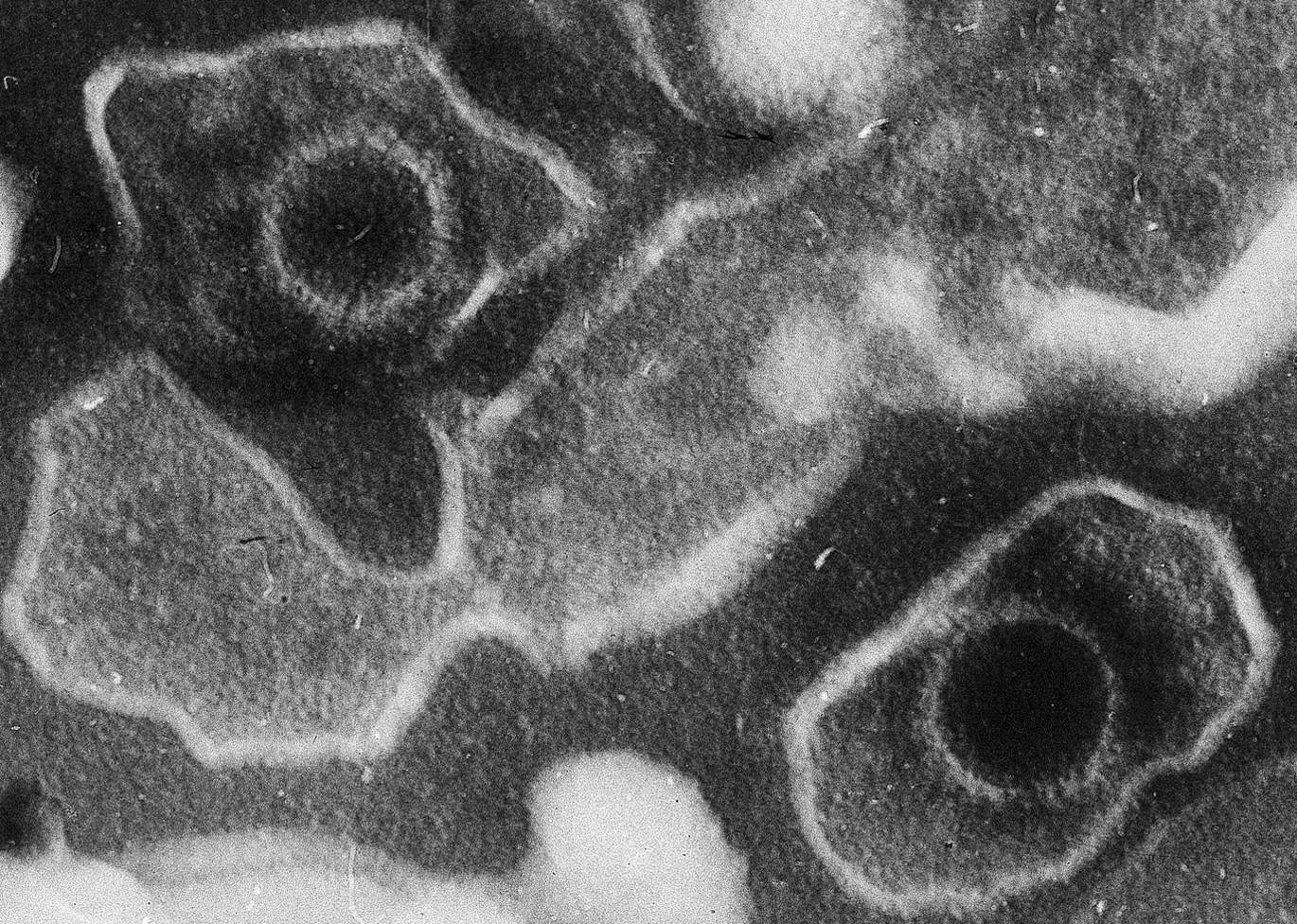 Roztroušenou sklerózu zřejmě způsobuje virus. Má ho v sobě skoro každý