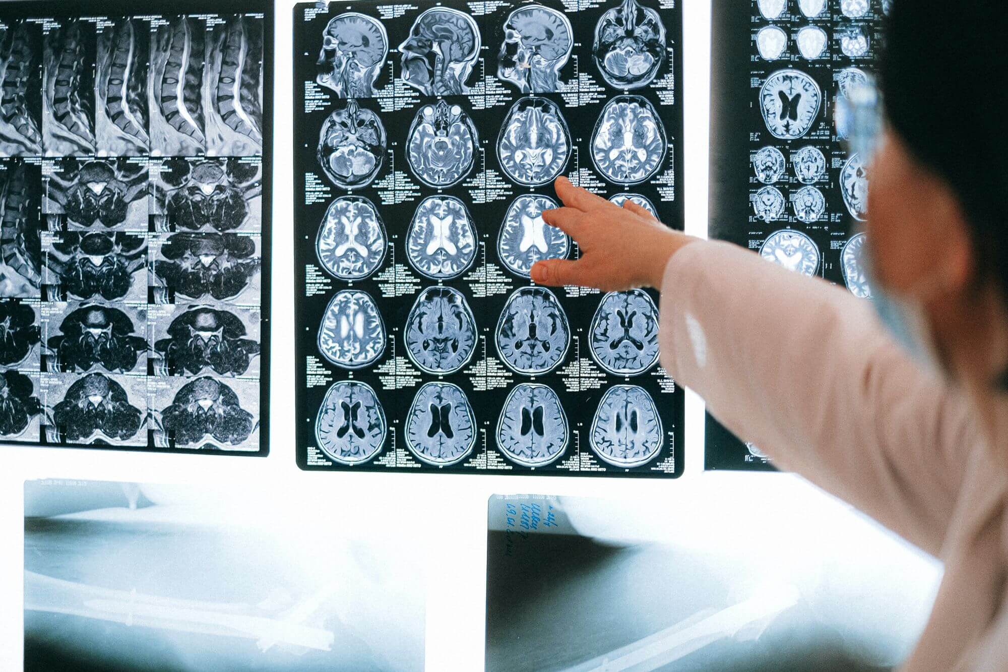 Roztroušenou sklerózu zřejmě způsobuje virus. Má ho v sobě skoro každý