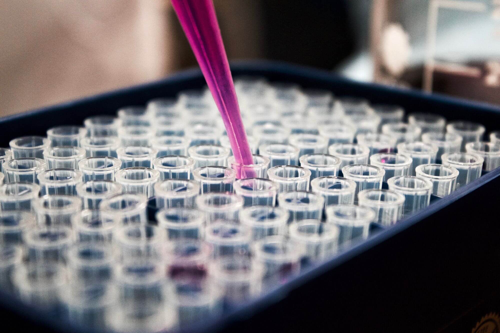 Screening vzorků stolice by mohl odhalit časné fáze rakoviny slinivky